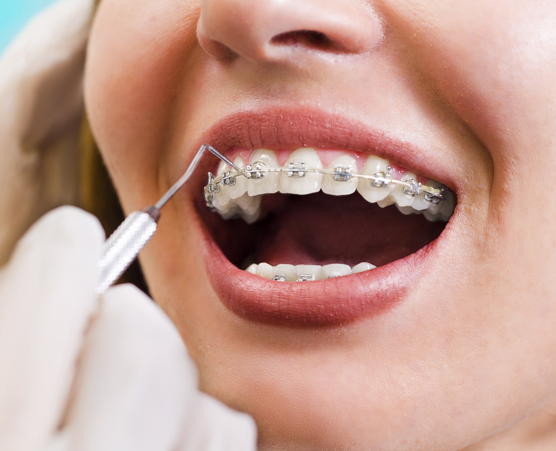 How Dentists Treat and Prevent Root Resorption in Orthodontic Patients