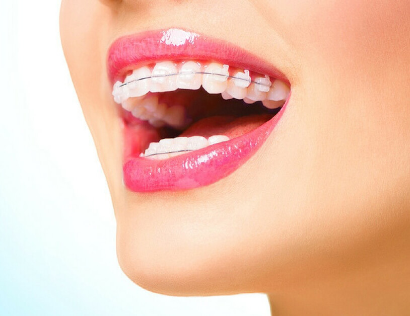 How Proper Tongue Posture Can Improve Orthodontic Results