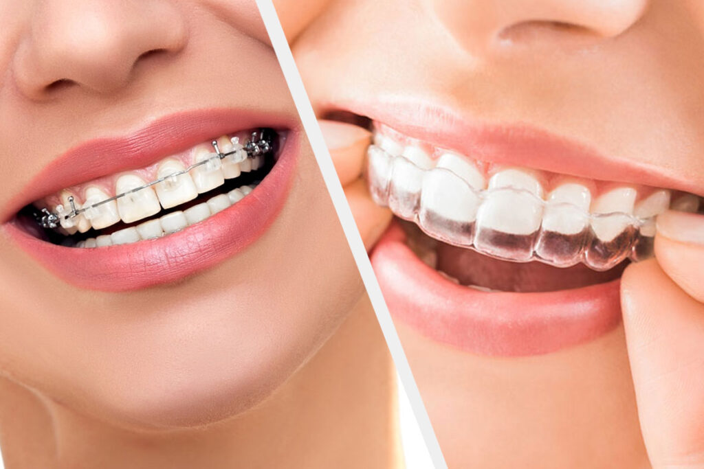 Invisible Aligners vs. Traditional Braces: A Comprehensive Guide for Adults