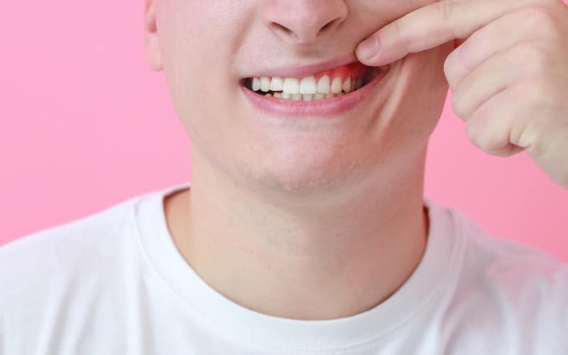 The Impact of Gum Recession on Oral Health and Modern Solutions for Rejuvenation